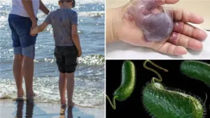 وفاة 4 أشخاص في فلوريدا بسبب “البكتيريا الآكلة للحوم”