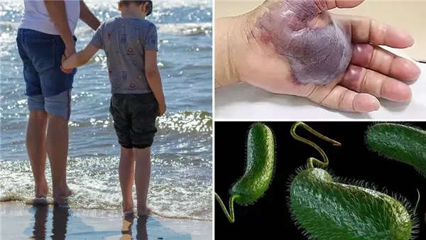 وفاة 4 أشخاص في فلوريدا بسبب “البكتيريا الآكلة للحوم” 