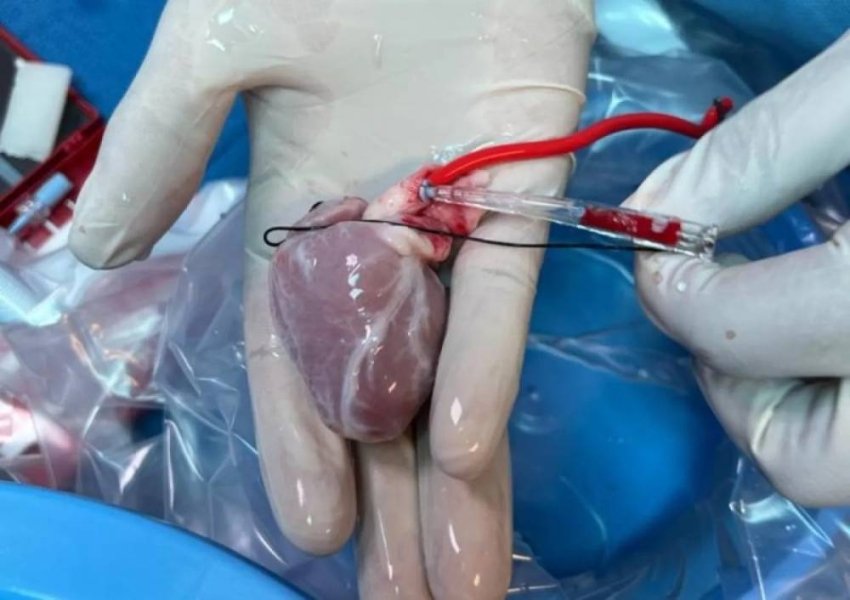 في أمريكا.. زراعة قلب جزئية تعيد الأمل  للأطفال المصابين بعيوب خلقية 