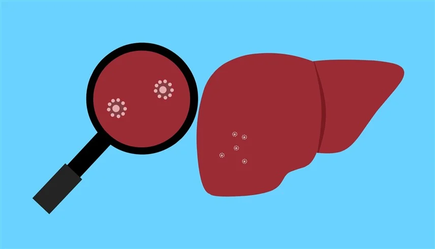 حقائق جديدة عن احتمالات الوقاية من سرطان الكبد 