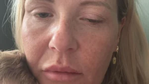 في بريطانيا.. حقن تجميل مزيفة تسبب مرضاً نادراً