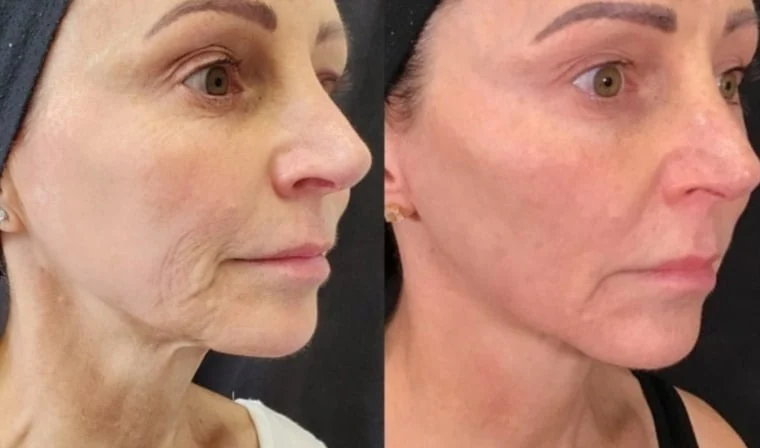  15 مليون أمريكي يستخدمون أدوية لإنقاص الوزن وإقبال على عمليات شد الوجه 