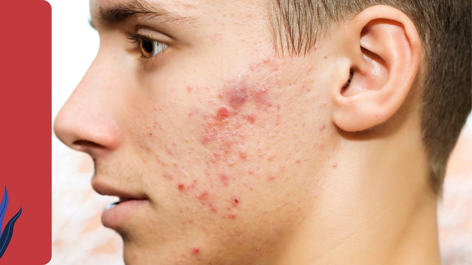 وداعًا لحَب الشباب: ابتكار علاجي جديد يقضي عليه في 7 أيام فقط 