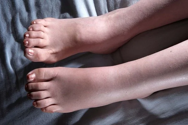 أعراض تصاحب تورّم الكاحل تنذر بخطر شديد 