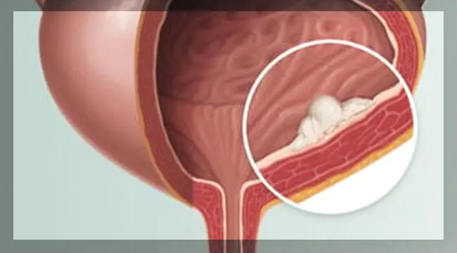 الرجال معرضون وراثيًا لسرطان المثانة أكثر من النساء 
