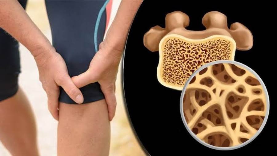 هشاشة العظام.. مرض صامت يهدد امرأة من كل 3 فوق الخمسين 