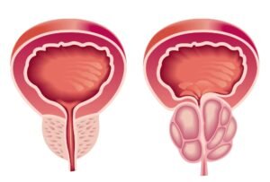 في بريطانيا.. تقنية الذكاء الاصطناعي تشخص سرطان البروستاتا في اليوم نفسه