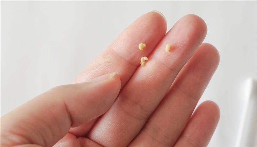 حصوات اللوزتين.. سبب رئيسي وراء الرائحة الكريهة للفم 