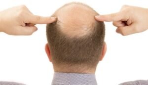 أمل جديد لمصابي الصلع: مصل مبتكر يُعيد نمو الشعر في 20 يوماً وفقاً لدراسة تايوانية