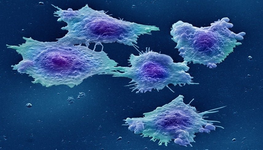 تقنية جديدة تُدمر 90% من خلايا السرطان بالضوء في 30 دقيقة