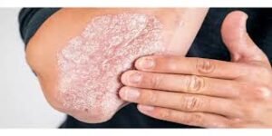 في يومها العالمي ..أفضل خيارات العلاج للصدفية بأنواعها