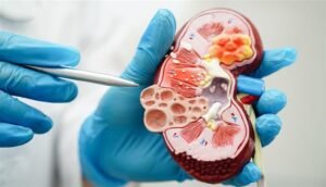 مرض الكلى المزمن يدخل قائمة “أكثر 10 أسباب للوفاة عالميًا” لأول مرة