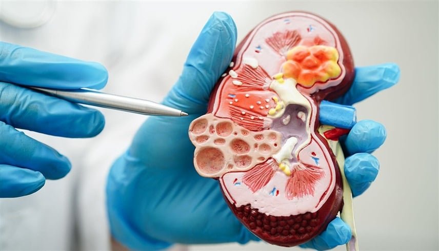 مرض الكلى المزمن يدخل قائمة “أكثر 10 أسباب للوفاة عالميًا” لأول مرة 