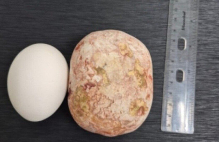 أطباء روس يستخرجون حصوة “عملاقة” تزن كيلوغراماً من مثانة رجل 