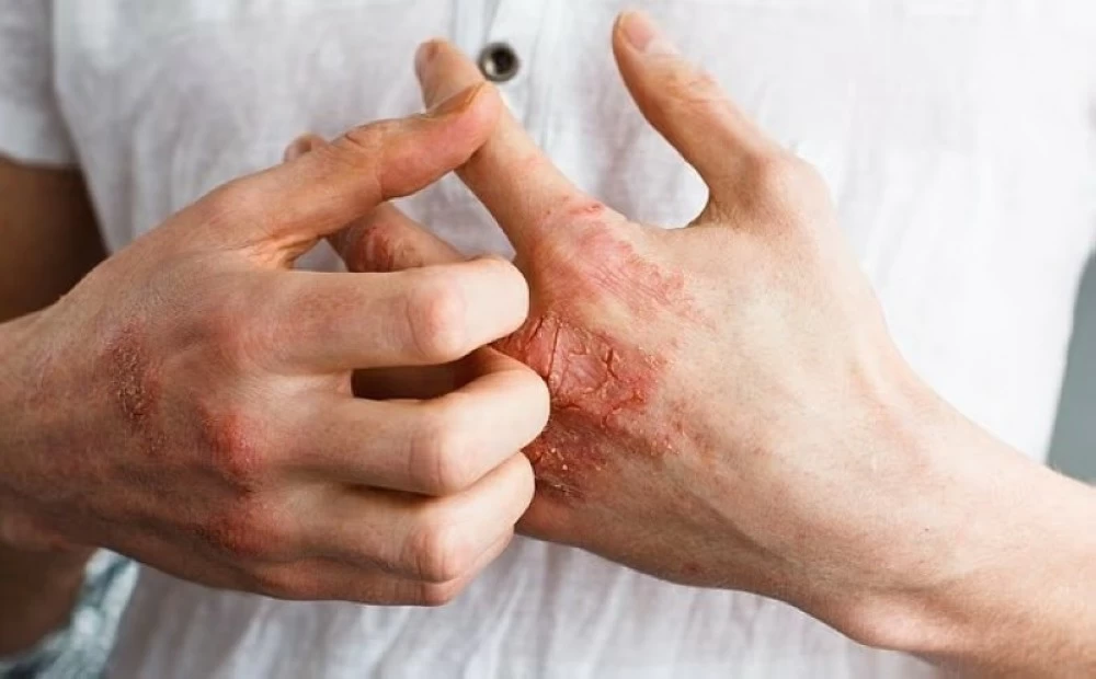 الطقس البارد يرفع خطر النوبات القلبية 10% والسلطات البريطانية تحذّر 