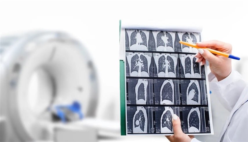 دراسة: توسيع فحص سرطان الرئة يضاعف الوفيات المتجنَّبة 3 مرات بين المدخنين 