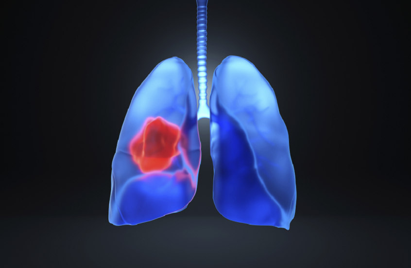 اكتشاف: “الالتهاب” سبب رئيسي لظهور سرطان الرئة في مراحله المبكرة 