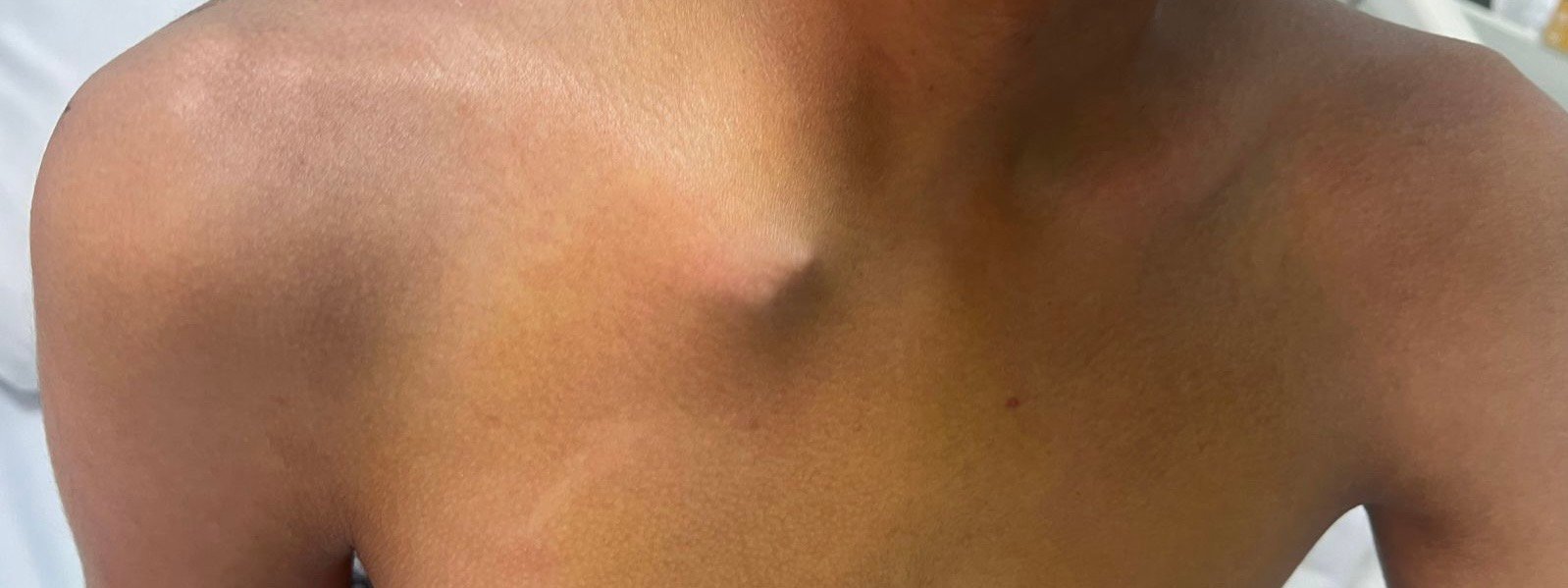 “مدينة الملك سعود الطبية” تُنقذ شاباً من إصابة خطيرة في مفصل الترقوة 