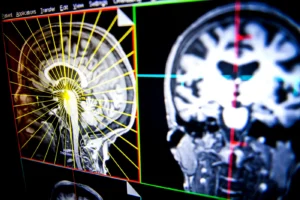 اكتشاف الطفرة الجينية المسؤولة عن الإصابة بالأمراض العقلية