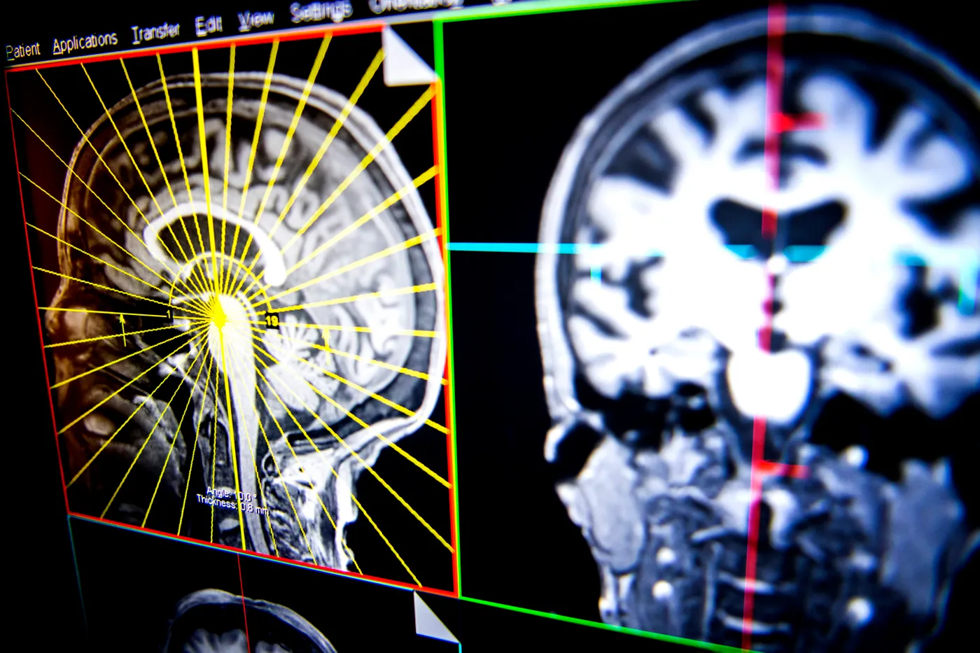 اكتشاف الطفرة الجينية المسؤولة عن الإصابة بالأمراض العقلية 