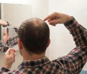 “كلاسكوترون”: أول علاج موضعي للصلع يعيد نمو الشعر دون آثار هرمونية عامة