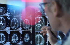 دواء “ليكانيماب” يؤخر تطور ألزهايمر 8 سنوات