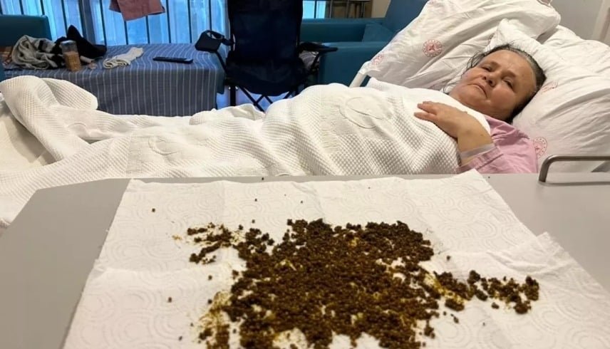 استخراج 20 ألف حصوة من مرارة مريضة 