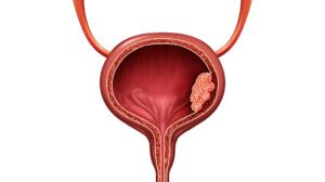 التهاب المثانة بعد العلاقة “الحميمية”