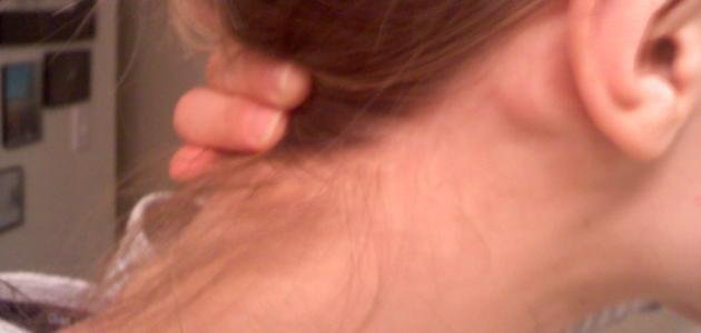 ورم بلا ألم خلف الأذن.. متى يكون إشارة خطر وتستدعي استشارة الطبيب؟ 