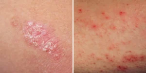 حقنة “نيموليزوماب” تمنح مرضى الإكزيما راحة من الحكة خلال 48 ساعة