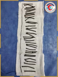 نجاح طبي بمصر في استخراج 34 مسماراً من معدة سيدة دون جراحة