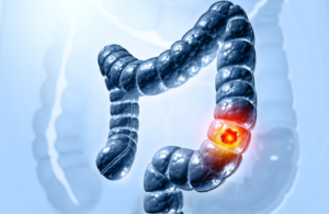 كيف يمهد “تصلب القولون” الطريق لإصابة الشباب بالسرطان؟