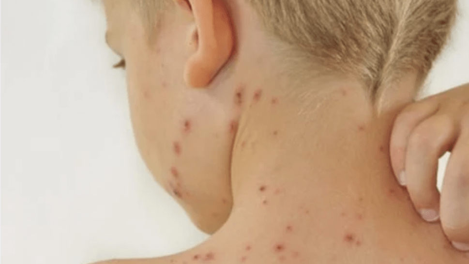 الجرب يغزو المملكة المتحدة بمعدلات قياسية 