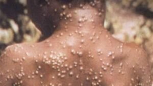 رسمياً.. “إمبوكس” يغادر قائمة الطوارئ الصحية في أفريقيا