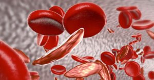 بصمة وراثية معقدة: اجتماع “المنجلية” و”الثلاسيميا” يهدد الأجيال بمرض مشترك