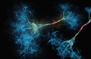 الذكاء الاصطناعي يكتشف وجهين جديدين للتصلب المتعدد