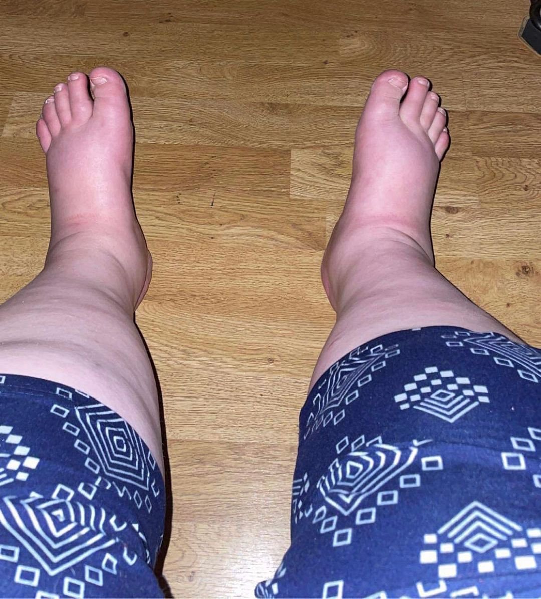 أزمة تورم القدمين بعد الولادة.. ظاهرة طبيعية لا تدعو للقلق 