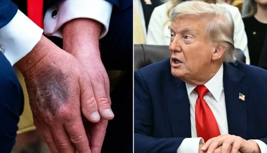 “خديعة الجرعة العالية”.. تحذيرات طبية بعد اعتراف ترمب عن الأسبرين 