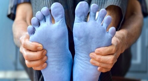 سر برودة الأطراف وعلاقتها بالأمراض المزمنة 