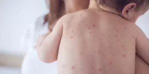 الحصبة تدق الأبواب من جديد.. إصابة 60 طفلاً بلندن بسبب عدم تلقى اللقاح