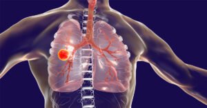 الصحة تحذر: تناول أدوية الدرن مع الطعام يهدد بظهور بكتيريا “فتاكة”