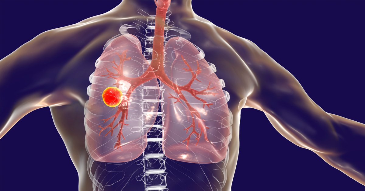 الصحة تحذر: تناول أدوية الدرن مع الطعام يهدد بظهور بكتيريا “فتاكة” 