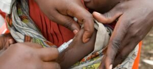 إطلاق حملة تطعيم ضدّ الحمى الصفراء في الكاميرون