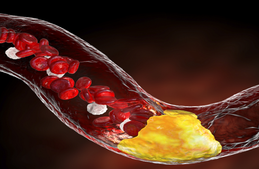 مراجعة طبية كبرى.. هل ظُلم الكوليسترول في محكمة القلب؟ 