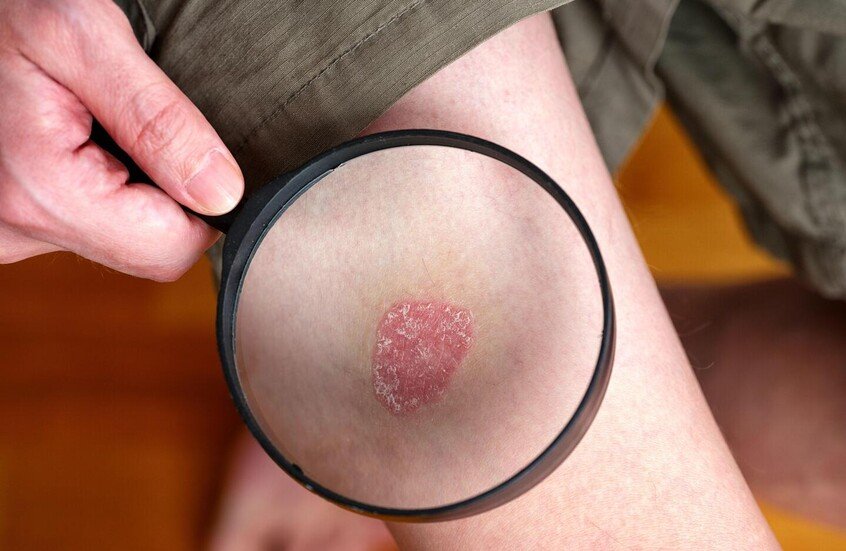 أنظمة غذائية نباتية قد تساهم في تهدئة الصدفية 