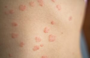 دراسة سويدية تكشف صلة حيوية بين الصدفية واضطرابات الأمعاء