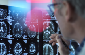 أدوية متداولة في سباق مواجهة ألزهايمر